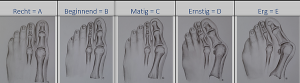 Hallux valgus. Welke categorie heb jij? Scheve grote teen kan door oefeningen rechter worden.December aanbieding online voetentrainingen hallux valgus